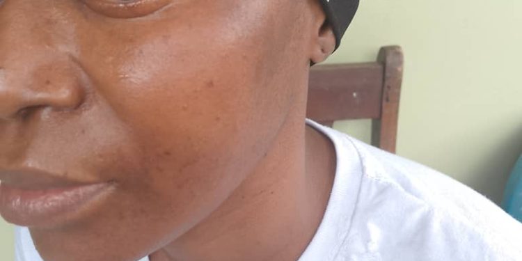 URGENT : S.O.S POUR DAME KADIATOU CAMARA, AGEE DE 39 ANS QUI SOUFFRE DE MENINGIOME DU JUGUM